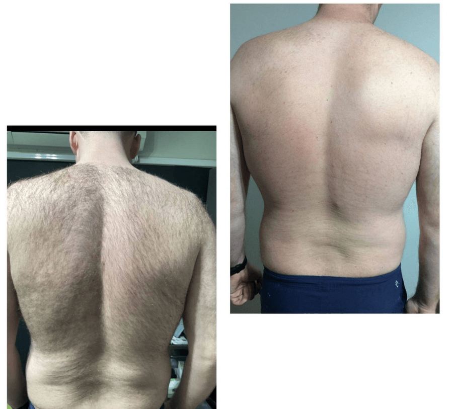 IPL hair removal — before & after