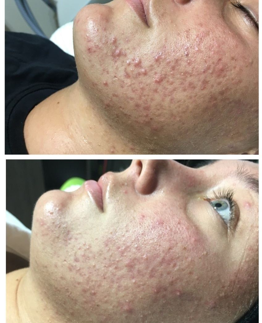 Pigmentation — before & after