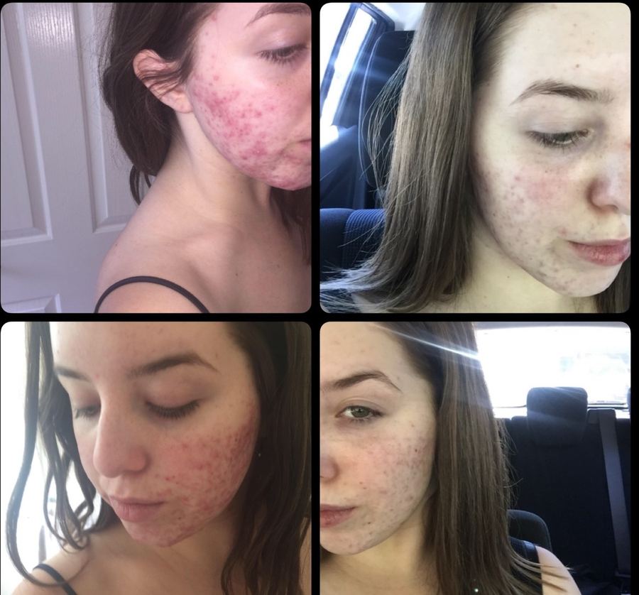 Acne treatment — before & after