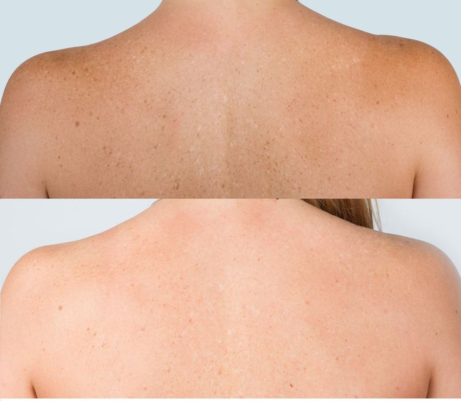 Photo facial — before & after