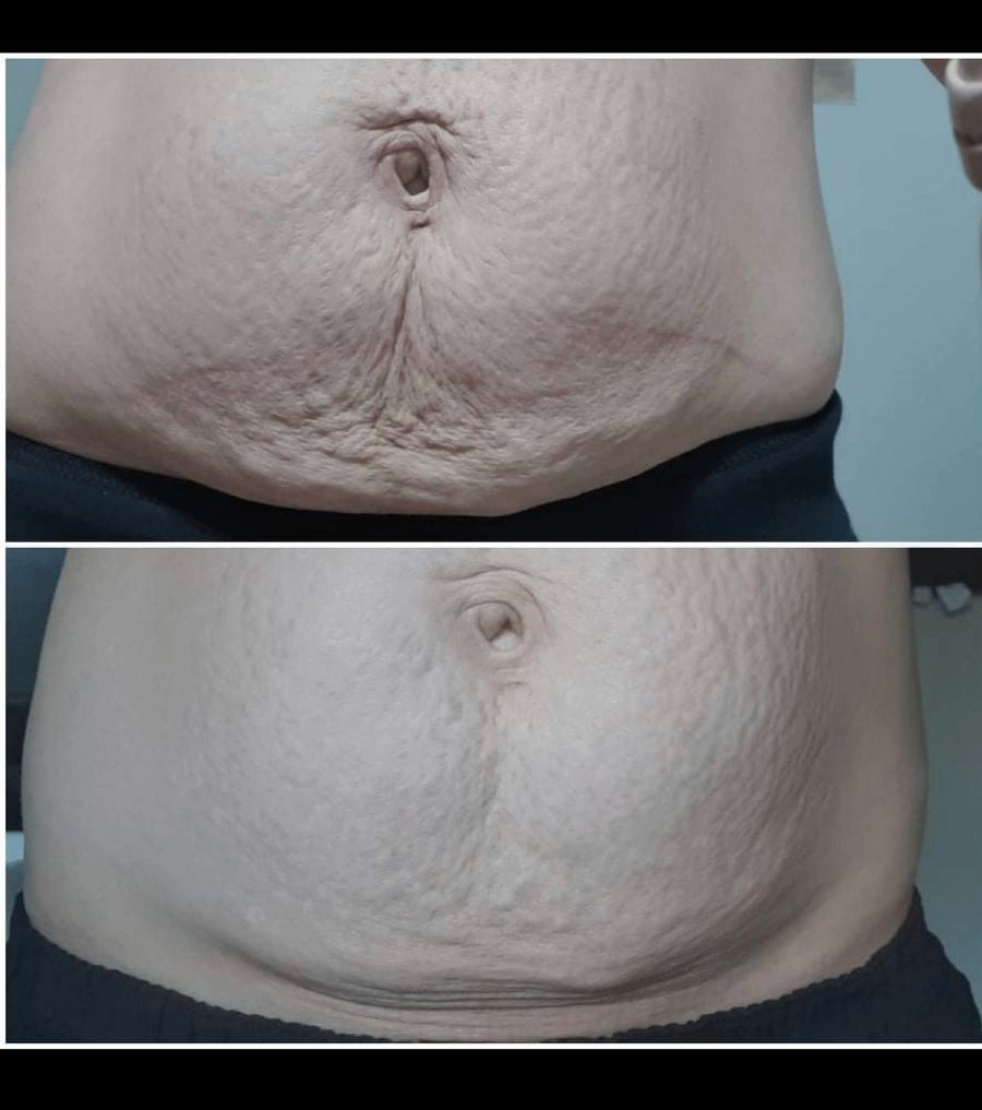 Body contouring — before & after