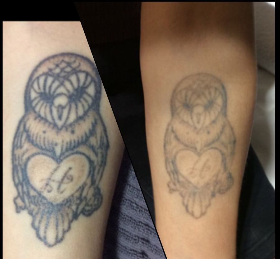 Before & after picosecond