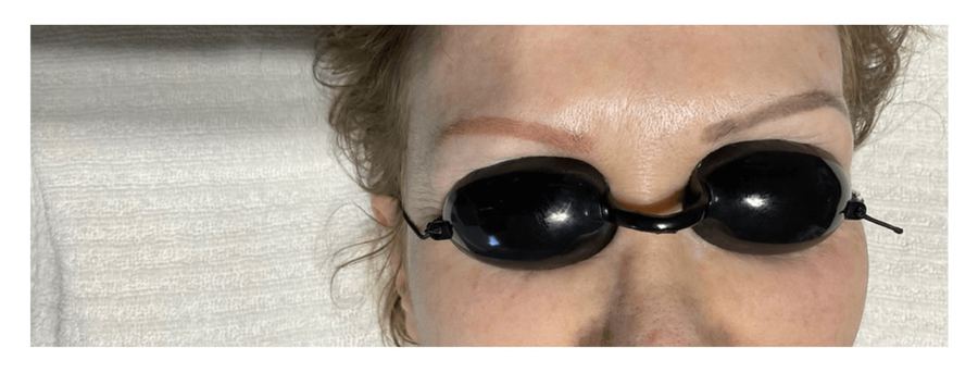 Eyebrow tattoo removal