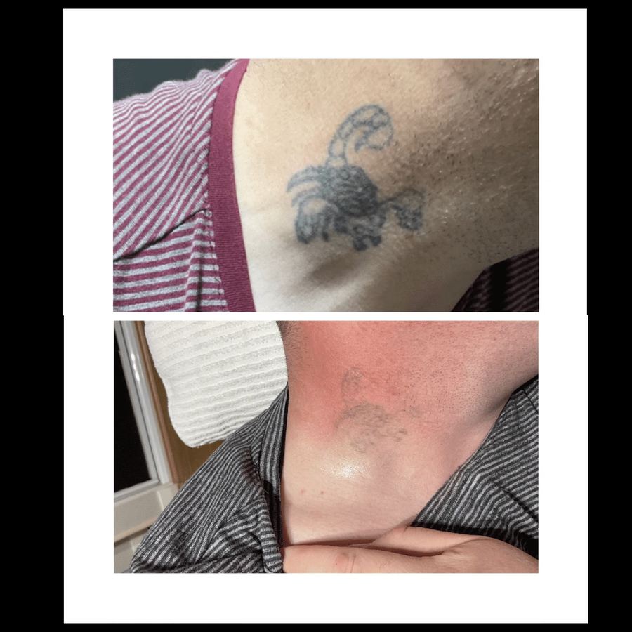 Neck tattoo — 4 sessions