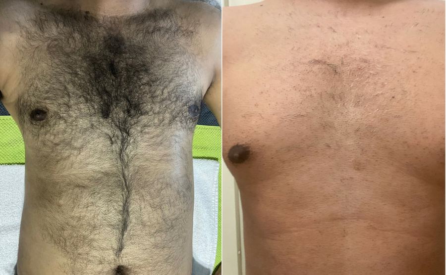 Men's IPL hair removal