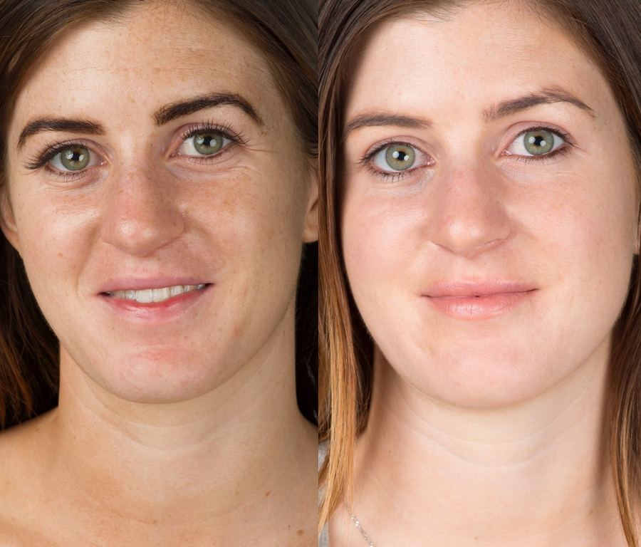Skin needling
